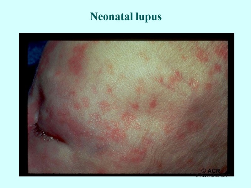 Neonatal lupus 8 December 2017